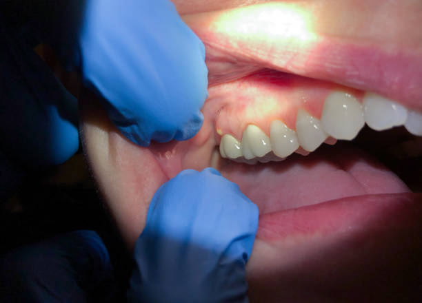 Best Emergency Dentist for Lost Fillings or Crowns in Mccook, NE